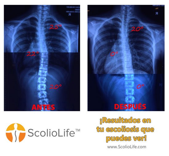 Xrays-before-and-after-17-ES
