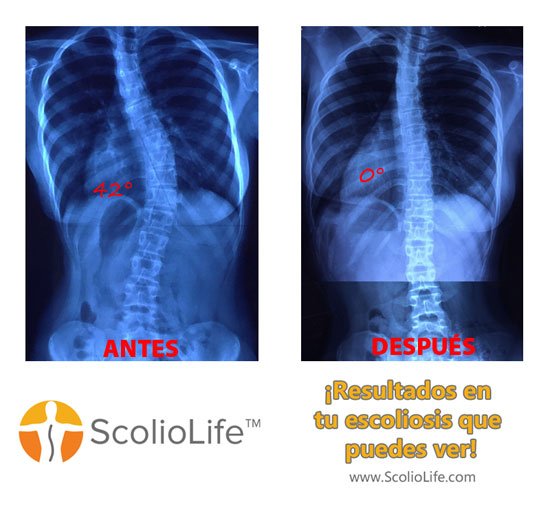 Xrays-before-and-after-18-ES