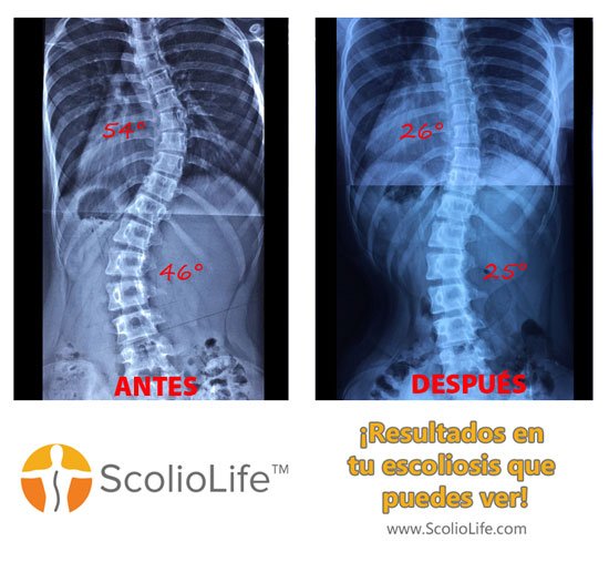 Xrays-before-and-after-19-ES