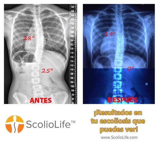 Xrays-before-and-after-20-ES