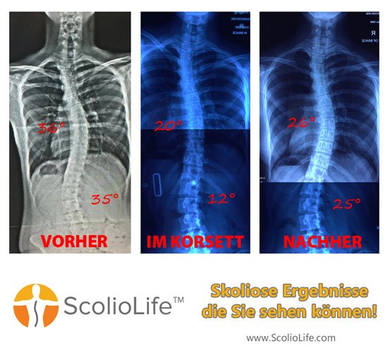 Xrays-before-and-after-22-DE