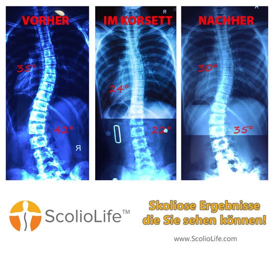 Xrays-before-and-after-24-DE