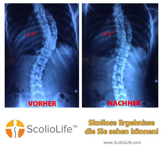 Xrays-before-and-after-25-DE