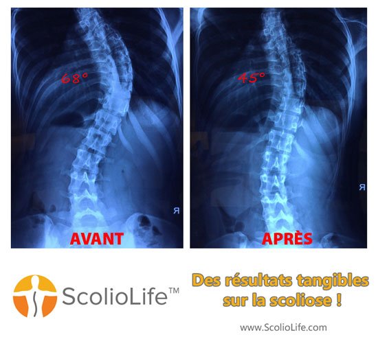 Xrays-before-and-after-25-FR