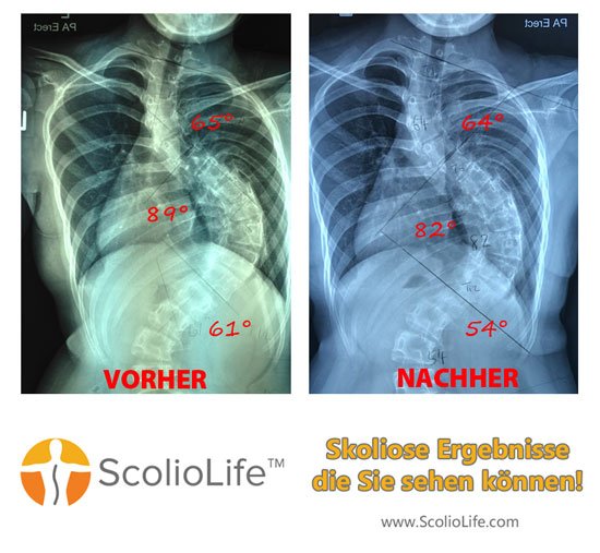 Xrays-before-and-after-28-DE