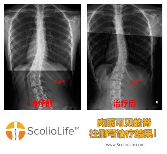 Xrays before and after 29 CN
