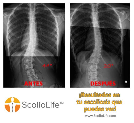 Xrays before and after 29 ES
