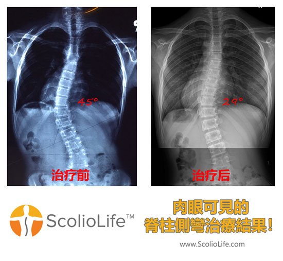 Xrays before and after 30 CN
