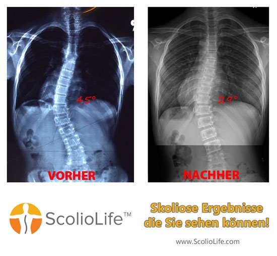 Xrays before and after 30 DE