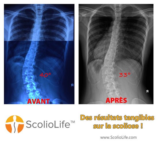 Xrays before and after 32 FR