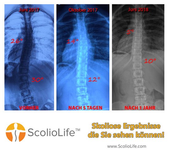 Xrays before and after 34 DE