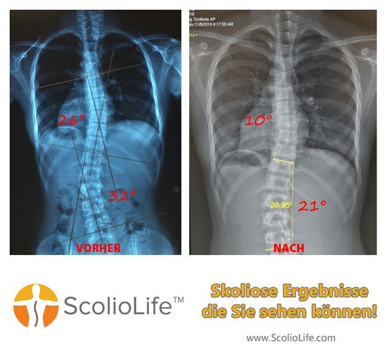 Xrays before and after 35 DE
