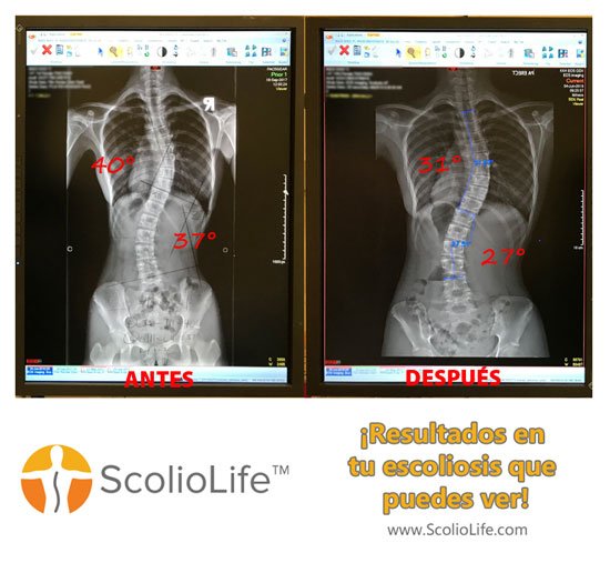 Xrays before and after 36 ES