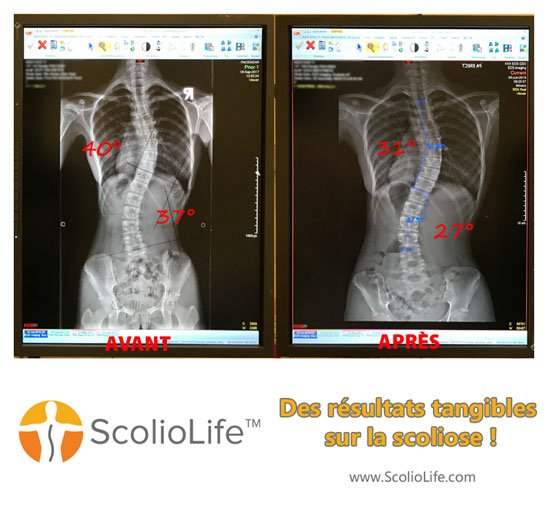 Xrays before and after 36 FR