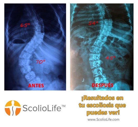 Xrays before and after 37 ES