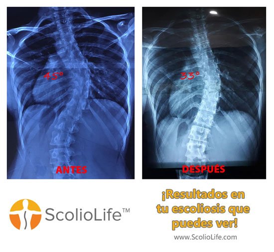 Xrays before and after 40 ES