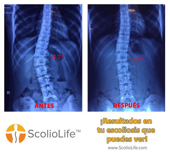 Xrays before and after 41 ES