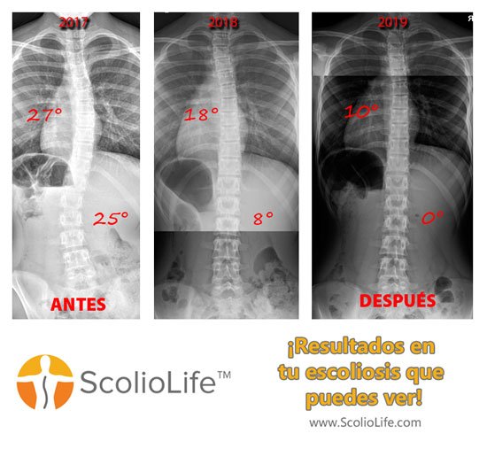 Xrays before and after 49 ES