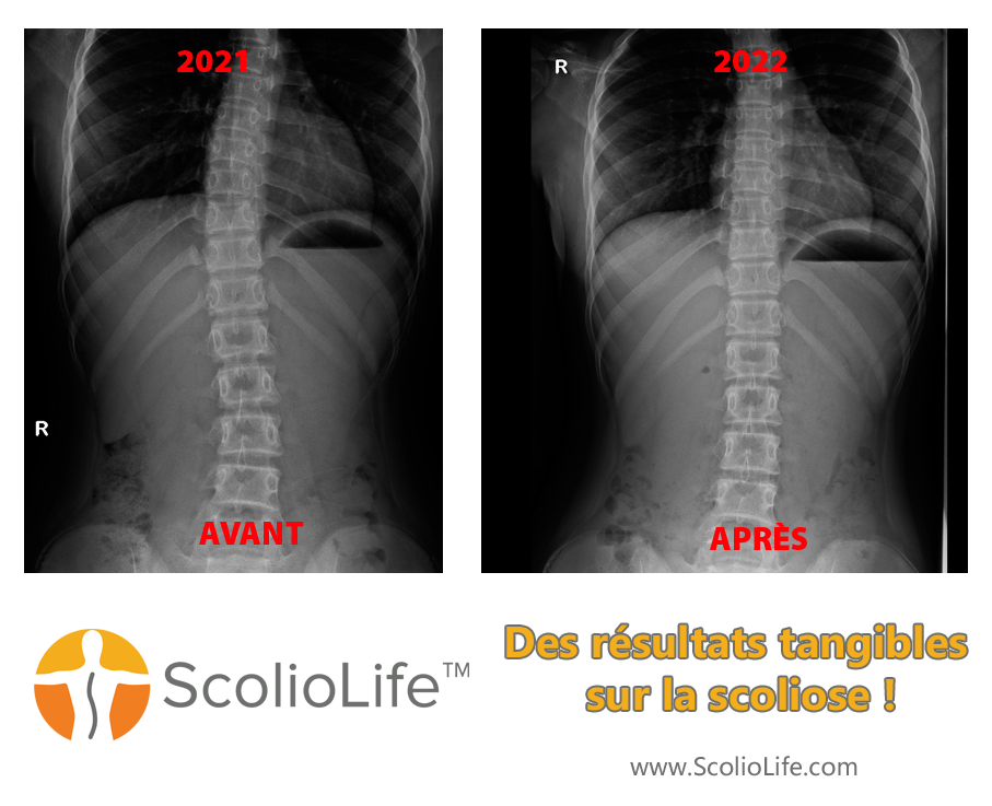 Xrays before and after 93